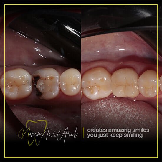 Emax Empress Dental Prices Istanbul Turkey Dt. Nazan Nur Arik